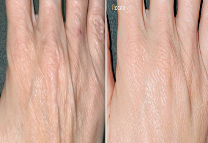Биоревитализация кожи рук