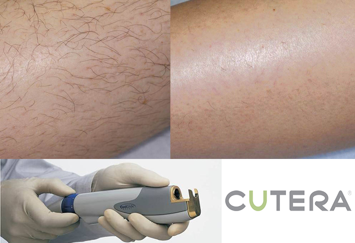 Работа наших врачей: удаление нежелательных волос неодимовым лазером Cutera.