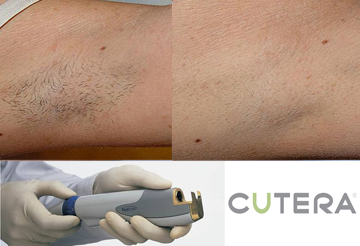 Работа наших врачей: удаление нежелательных волос неодимовым лазером Cutera.
